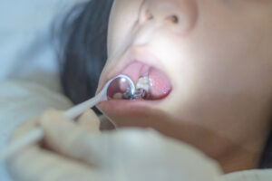 銀歯をしている患者さまの口内環境