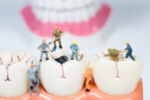 虫歯を治療しているイメージ図
