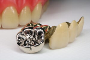 銀歯と金歯が並べられている