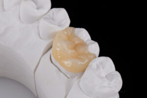 歯科模型に装着されたセラミックの歯