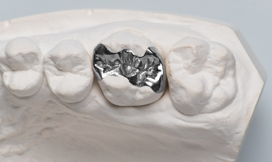 銀歯の模型
