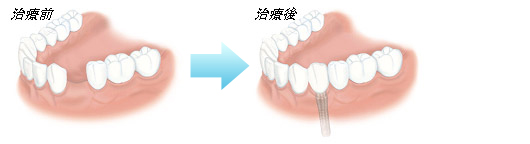 ふじみ野駅1分の歯科医院　榎本デンタルクリニック　インプラント　１本の歯が欠けている場合